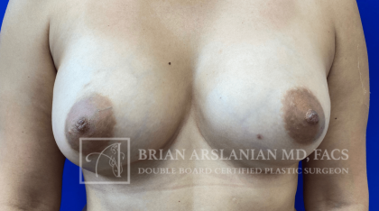 Breast Revision case #2769