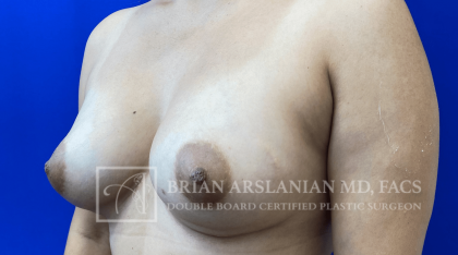 Breast Revision case #2769