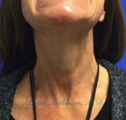 Botox® case #2381
