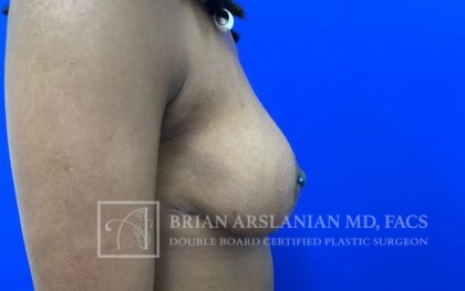 Breast Lift case #4766