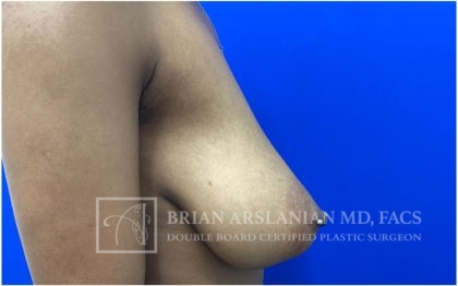 Breast Lift case #4766