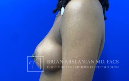 Breast Lift case #4766