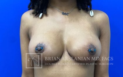 Breast Lift case #4766
