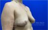 Breast Augmentation case #2735