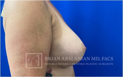 Breast Augmentation case #2735