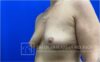 Breast Augmentation case #2735