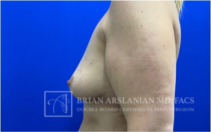 Breast Augmentation case #2735