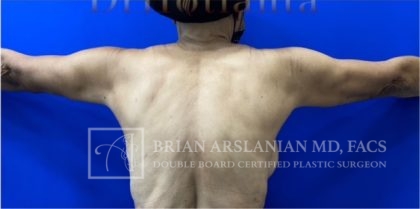 | Arslanian Plastic Surgery Atlanta Before & After Plastic Surgery Results | arm lift