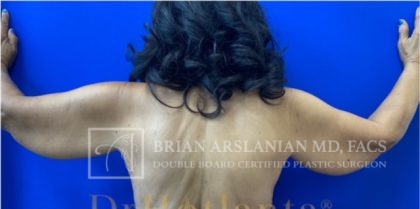 | Arslanian Plastic Surgery Atlanta Before & After Plastic Surgery Results | arm lift
