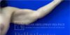 Arm Lift case #2104