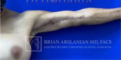 | Arslanian Plastic Surgery Atlanta Before & After Plastic Surgery Results | arm lift