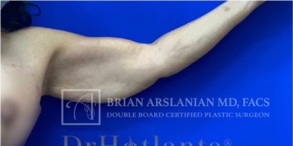 | Arslanian Plastic Surgery Atlanta Before & After Plastic Surgery Results | arm lift