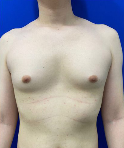 Gynecomastia case #4220