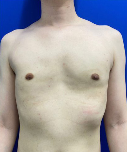 Gynecomastia case #4220