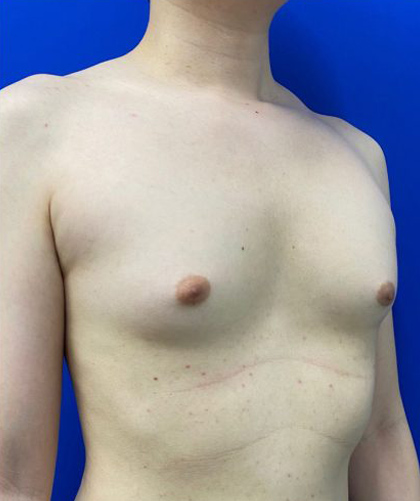 Gynecomastia case #4220