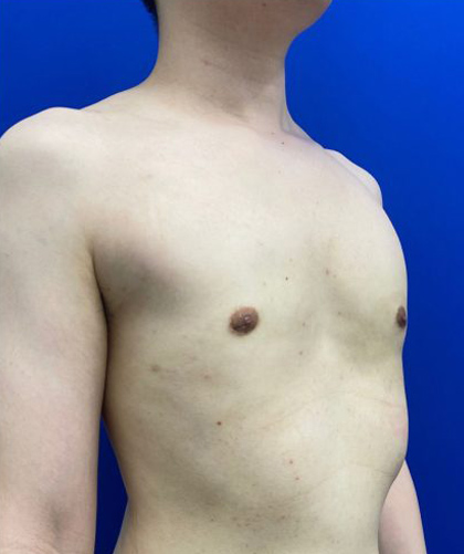 Gynecomastia case #4220