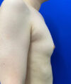 Gynecomastia case #4220