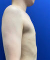 Gynecomastia case #4220