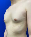 Gynecomastia case #4220