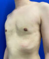 Gynecomastia case #4220