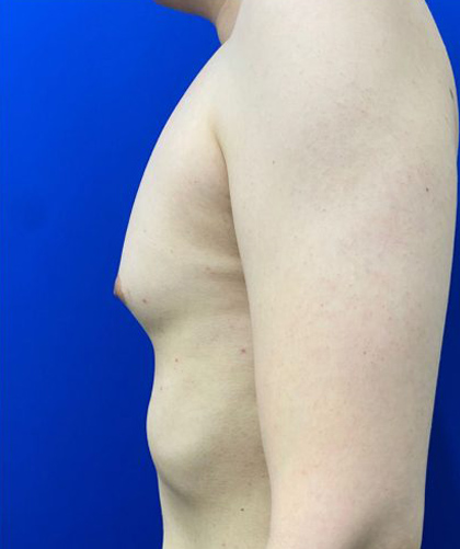 Gynecomastia case #4220