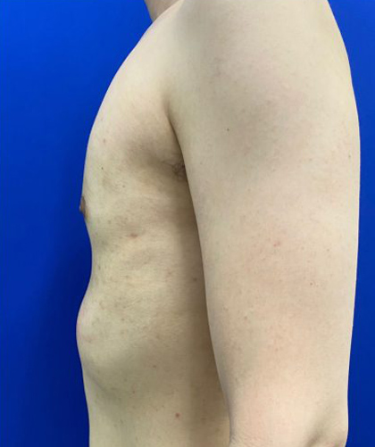 Gynecomastia case #4220