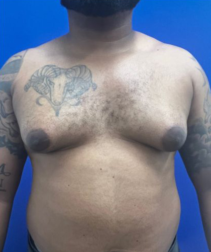 Gynecomastia case #4219