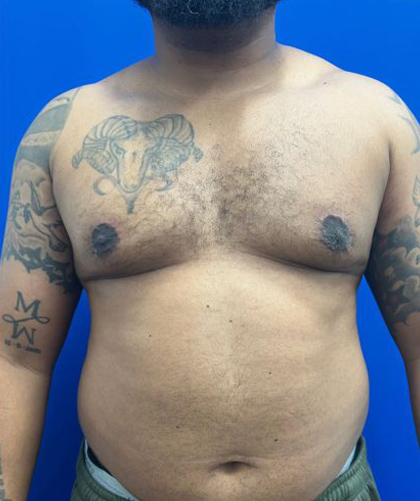 Gynecomastia case #4219