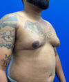 Gynecomastia case #4219