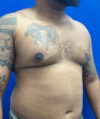 Gynecomastia case #4219