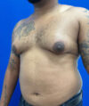 Gynecomastia case #4219