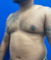 Gynecomastia case #4219