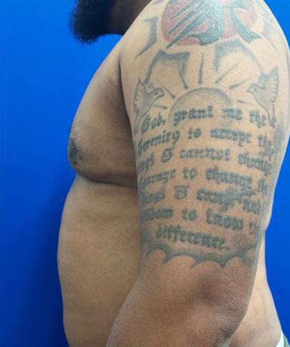 Gynecomastia case #4219