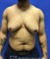 Gynecomastia case #4215