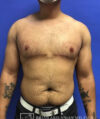 Gynecomastia case #4215