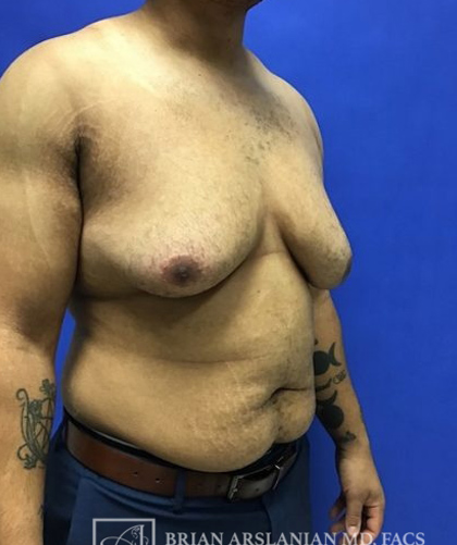 Gynecomastia case #4215