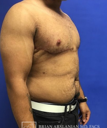 Gynecomastia case #4215