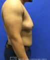 Gynecomastia case #4215