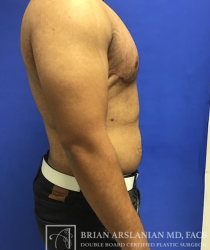 Gynecomastia case #4215