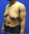 Gynecomastia case #4215