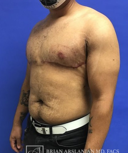 Gynecomastia case #4215