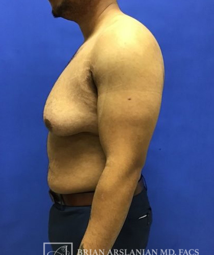 Gynecomastia case #4215