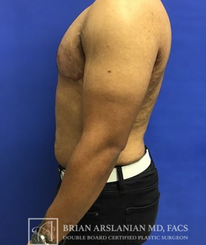 Gynecomastia case #4215