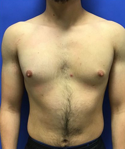 Gynecomastia case #4137