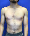 Gynecomastia case #4137