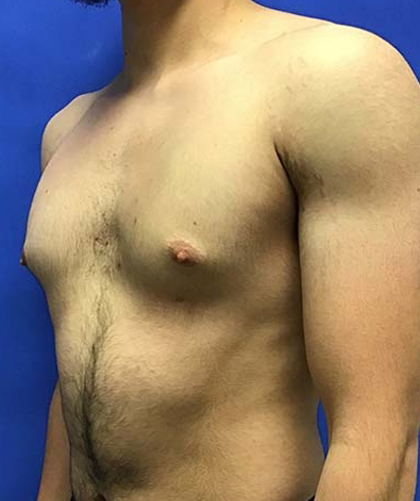 Gynecomastia case #4137