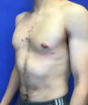 Gynecomastia case #4137