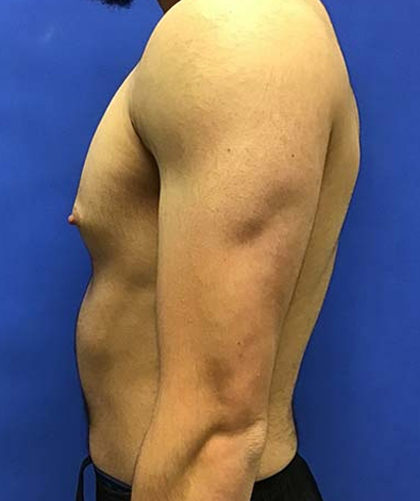 Gynecomastia case #4137