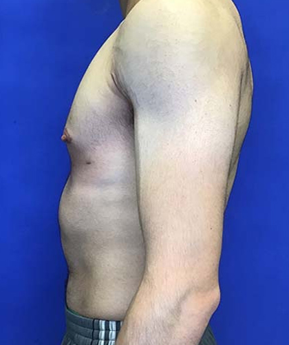 Gynecomastia case #4137