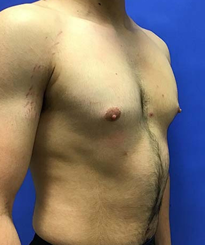 Gynecomastia case #4137